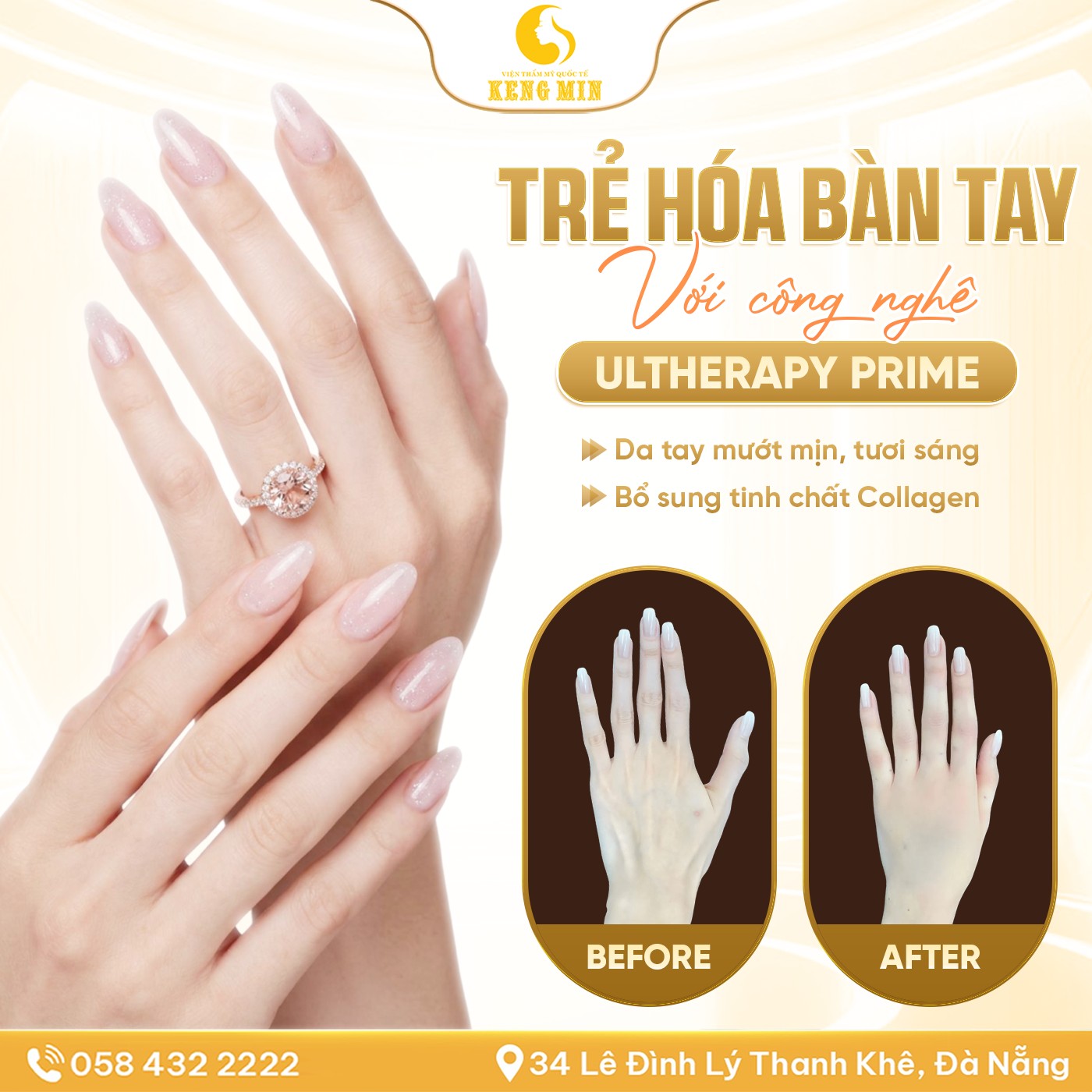 Trẻ Hóa Bàn Tay Bằng Sóng Siêu Âm Hội Tụ – Giải Pháp Xóa Nhăn, Căng Mịn Da Tay Tại Đà Nẵng