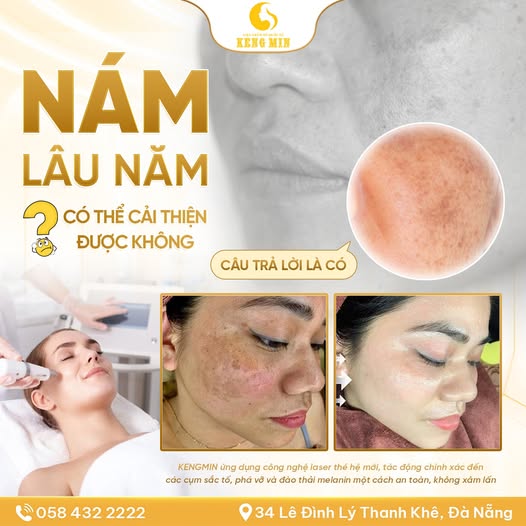 Điều Trị Nám Lâu Năm Hiệu Quả – Giải Pháp Lấy Lại Làn Da Sáng Mịn