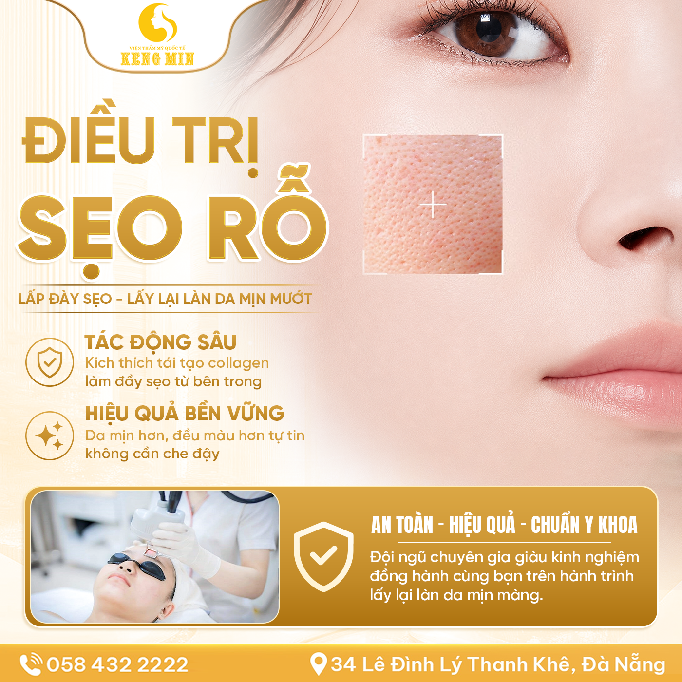 Điều Trị Sẹo Rỗ Hiệu Quả – Giải Pháp Lấy Lại Làn Da Mịn Màng, Tự Tin