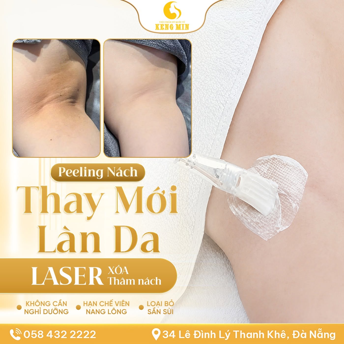 LASER XÓA THÂM NÁCH – GIẢI PHÁP LẤY LẠI VÙNG DA DƯỚI CÁNH TAY TRẮNG MỊN TẠI KENG MIN