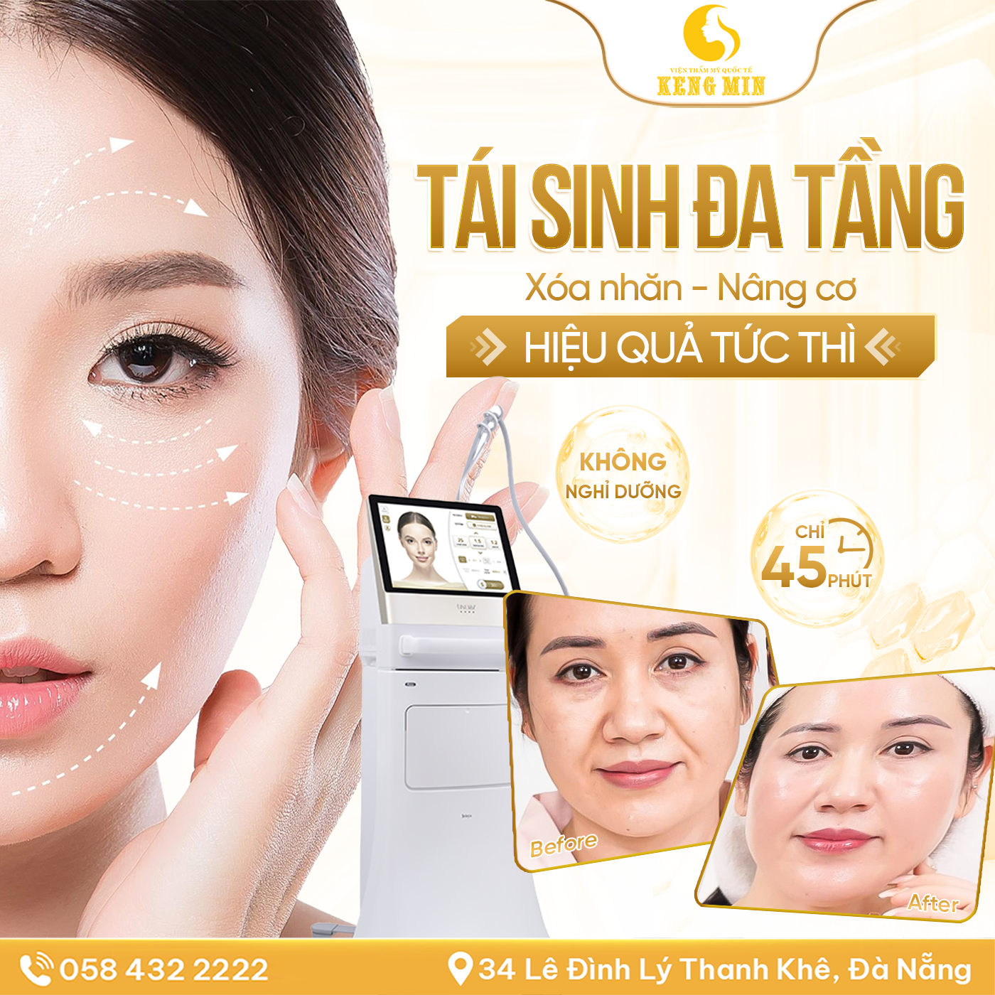 Tái Sinh Da Tầng – Giải Pháp Xóa Nhăn, Nâng Cơ Hiện Đại Giúp Làn Da Trẻ Hóa Tự Nhiên