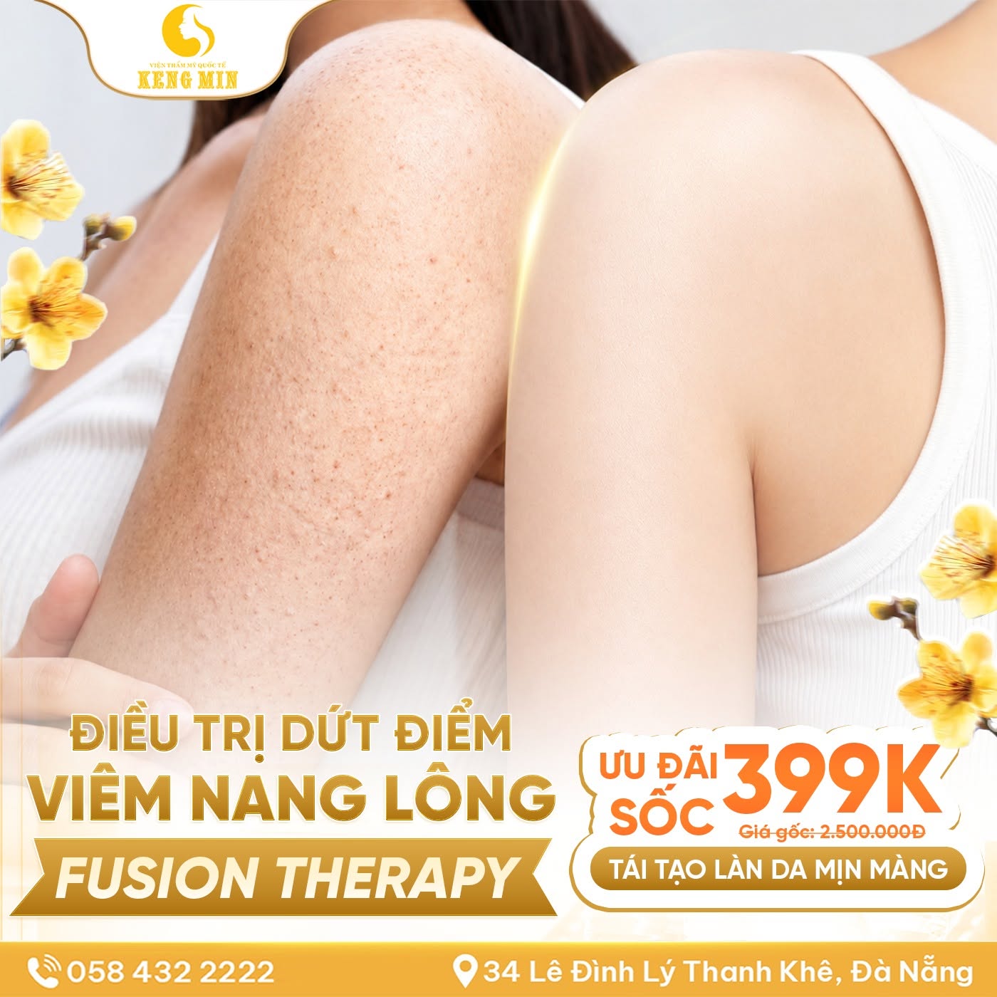 ĐIỀU TRỊ VIÊM NANG LÔNG FUSION THERAPY – GIẢI PHÁP CHO LÀN DA MỊN MÀNG, SẠCH VIÊM CHỈ TỪ 399K TẠI VIỆN THẨM MỸ QUỐC TẾ KENGMIN