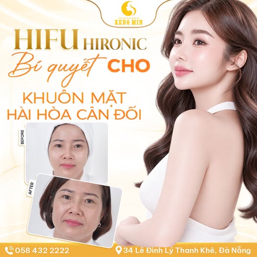 HIFU Hironic – Giải Pháp Nâng Cơ, Trẻ Hóa Và Thon Gọn Gương Mặt Không Phẫu Thuật