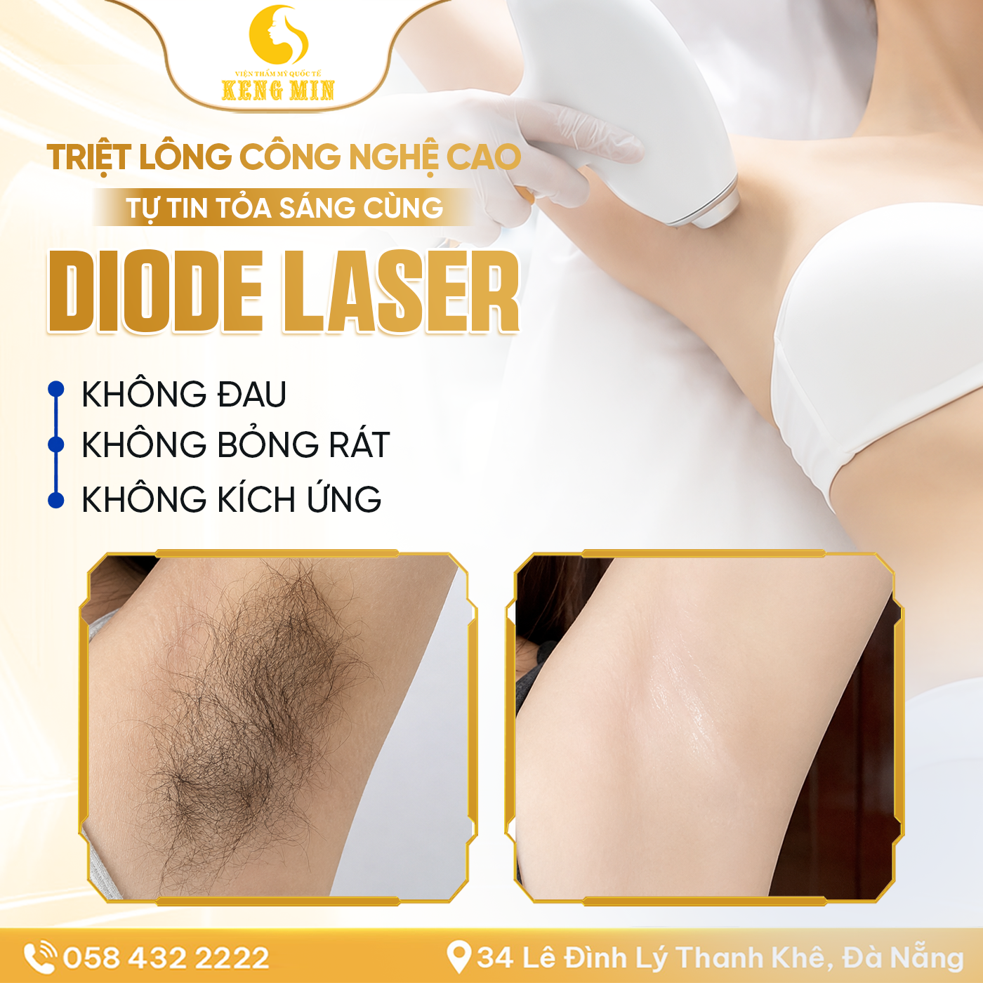 Triệt Lông Công Nghệ Cao Diode Laser – Giải Pháp Hỗ Trợ Giảm Lông, Cho Làn Da Mịn Màng Hơn