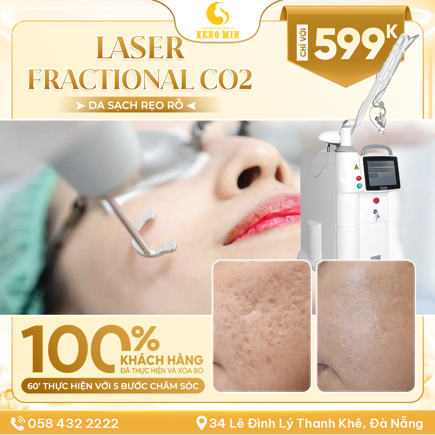 Laser Fractional CO2 – Giải Pháp Hỗ Trợ Cải Thiện Sẹo Rỗ, Tái Tạo Bề Mặt Da